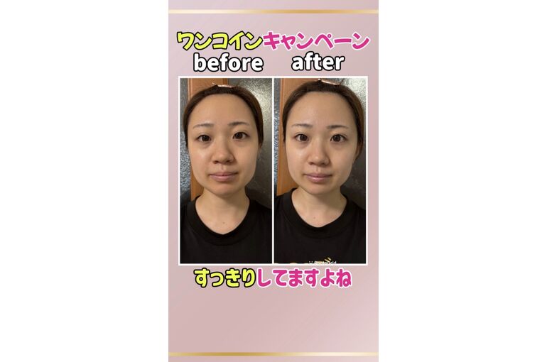 肩こり