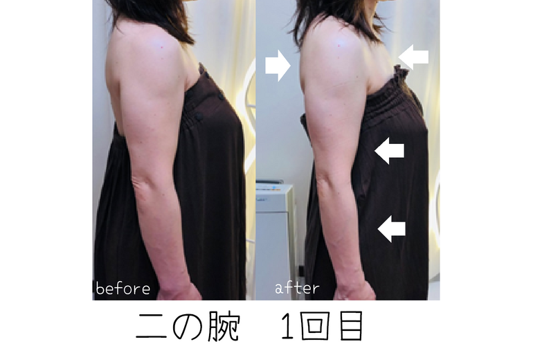 二の腕