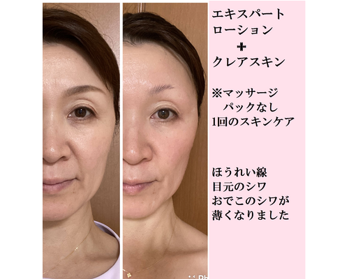 ほうれい線