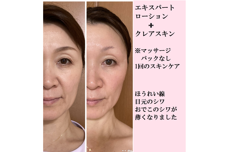 ほうれい線