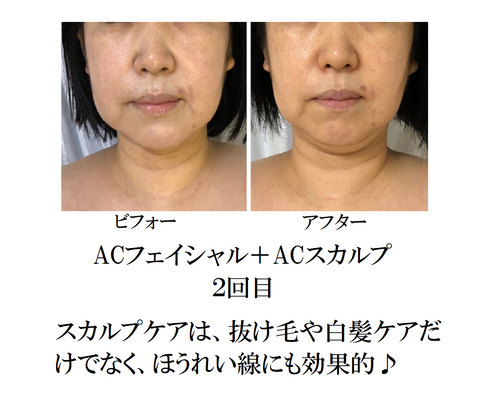 2回目　目の下　ほうれい線
